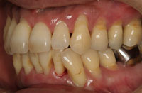 歯周病左側