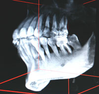 歯周病左側CT画像
