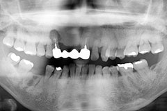 初診時レントゲン：右上犬歯の周りに腫瘍がみられる