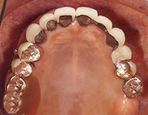 インプラントの長期症例（上顎）