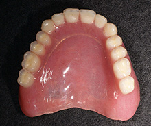 10年経過した総義歯の症例：上顎