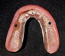 13年経過した総義歯の症例：上顎