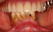 術前下顎歯槽堤