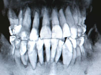 歯周病正面CT画像