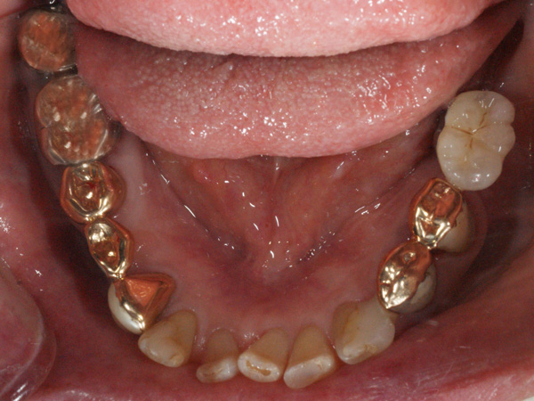 インプラントの長期症例（下顎）