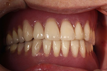 10年経過した総義歯の症例