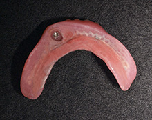 10年経過した総義歯の症例：下顎