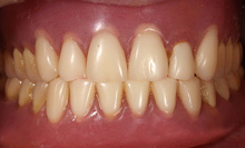 13年経過した総義歯の症例