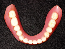 13年経過した総義歯の症例：下顎