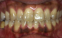 矯正治療 + メラニン除去（歯肉）+ ホワイトニング治療前
