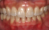 矯正治療 + メラニン除去（歯肉）+ ホワイトニング治療後