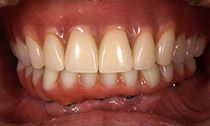 オーバーデンチャー症例 総義歯