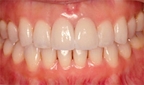 究極症例 :ホワイトニング後、前歯2本オールセラミッククラウン修復後