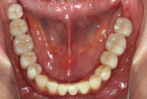 究極症例: 治療後下顎